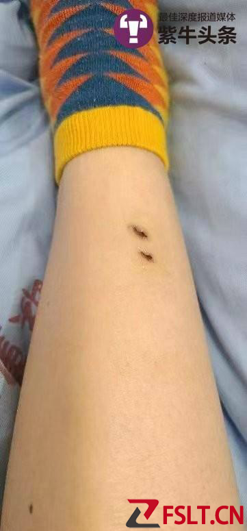 女子住酒店被毒蛇咬伤 酒店拒担全责 只愿承担过失责任